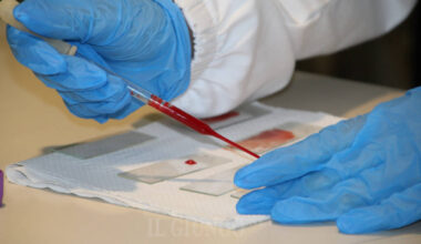 Caso di tubercolosi: colpito uno studente. La Asl sta chiamando i possibili contatti