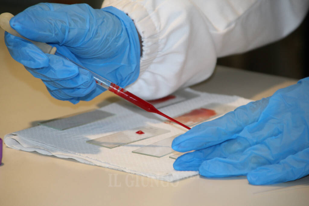 Caso di tubercolosi: colpito uno studente. La Asl sta chiamando i possibili contatti