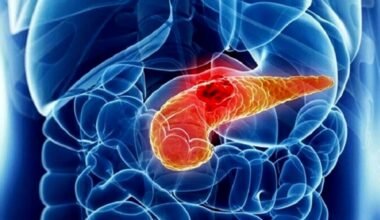 Elevato consumo di fruttosio e cancro al pancreas, quale relazione? Lo studio Unipd