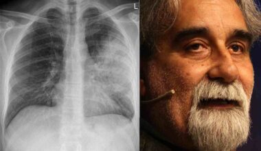 Polmonite interstiziale, la verità sulla malattia che ha ucciso il maestro Vessicchio | Questi sono i sintomi fantasma da non sottovalutare