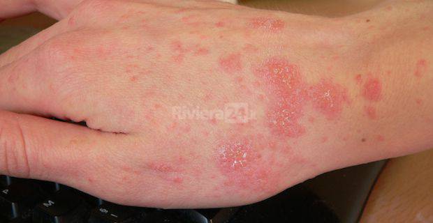 Scabbia, diversi casi a Ventimiglia. Asl invia circolare alle scuole