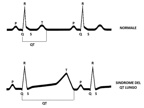 sindrome_del_qt_lungo_1