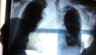 ogni anno in Italia 150mila ricoveri e 9mila morti