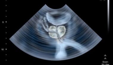 Tumore alla prostata: test gratuito del Psa