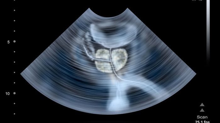 Tumore alla prostata: test gratuito del Psa