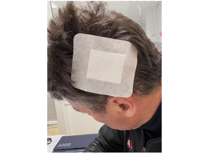 CONTUSIONI E PUNTI DI SUTURA ALLA TESTA