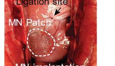 Un cerotto aiuta il cuore a guarire dopo un infarto. Si dissolve rilasciando sostanze nei tessuti lesionati