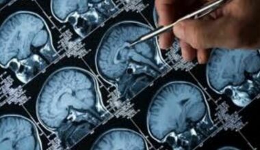 Alzheimer, lo studio rivela: &laquo;Rischia di pi&ugrave; chi vive nei Paesi del Nord Europa&raquo;