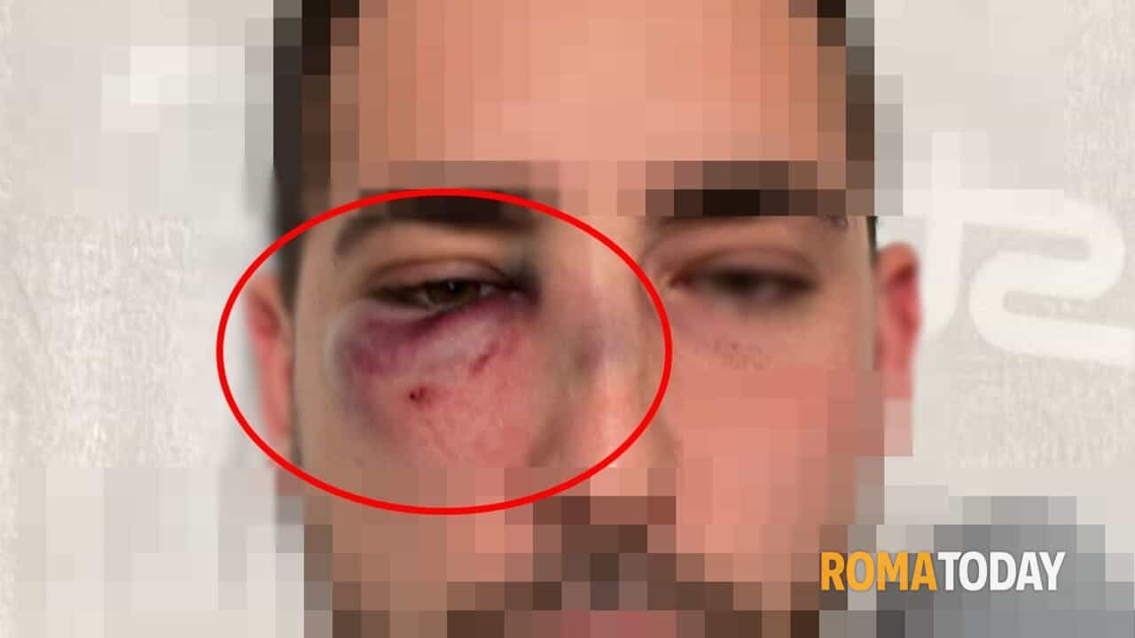 "Sono stato preso a pugni in discoteca senza motivo e nessuno del locale mi ha aiutato". Il racconto choc