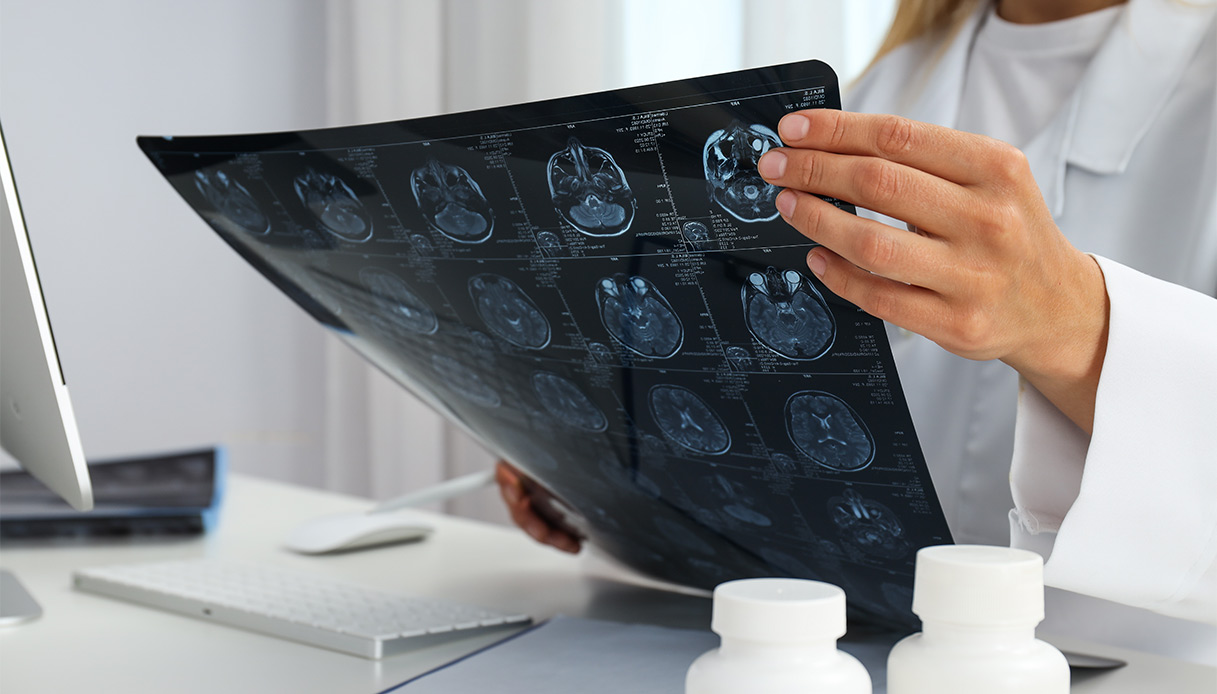 Glioblastoma, come si manifesta e come si affronta questo tipo di tumore al cervello