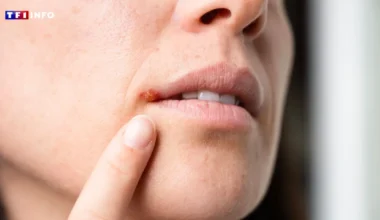 I veri colpevoli dei fastidiosi herpes labiali: il medico svela cosa li fa davvero apparire