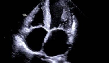 Troppe proteine nel cuore: il muscolo perde elasticità