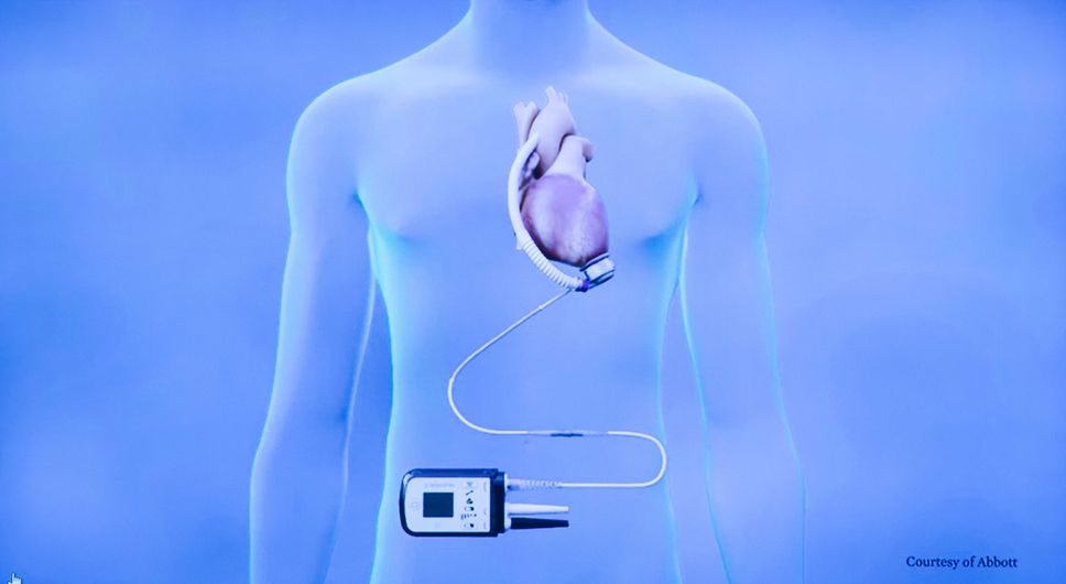 Le pazienti con cuore artificiale più longeve della nostra storia racconteranno la loro vita che da 10 anni dipende da uno «zainetto».