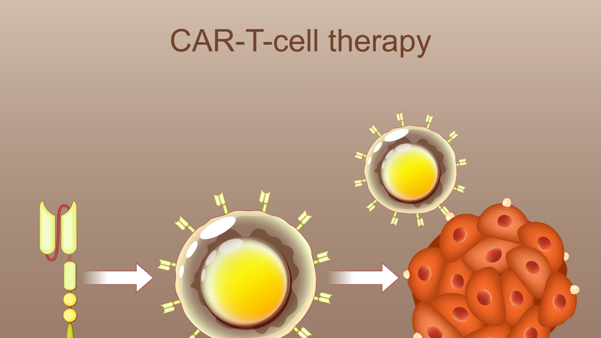 Linfomi, nuova terapia CAR-T disponibile per chi non ha benefici dalla cura di prima linea