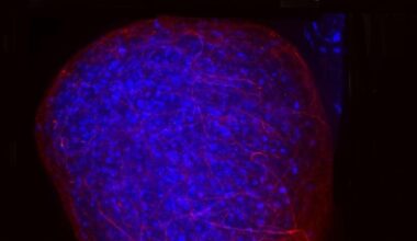 Sclerosi multipla, un «vecchio» farmaco può proteggere e riparare il tessuto nervoso