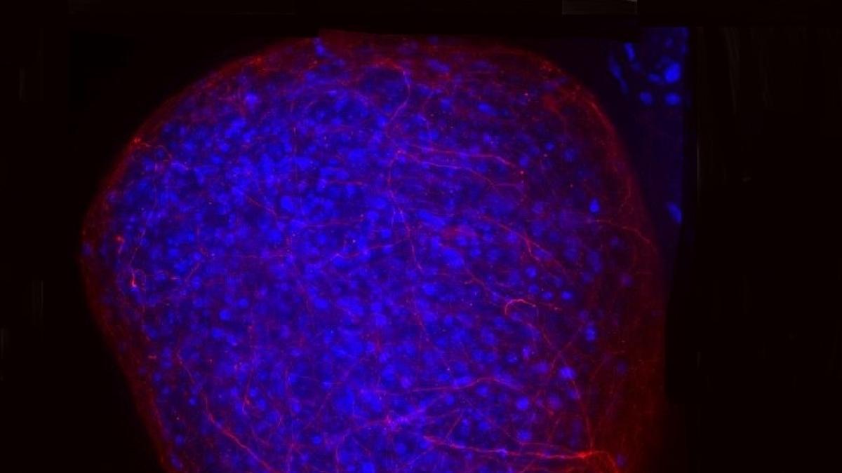 Sclerosi multipla, un «vecchio» farmaco può proteggere e riparare il tessuto nervoso