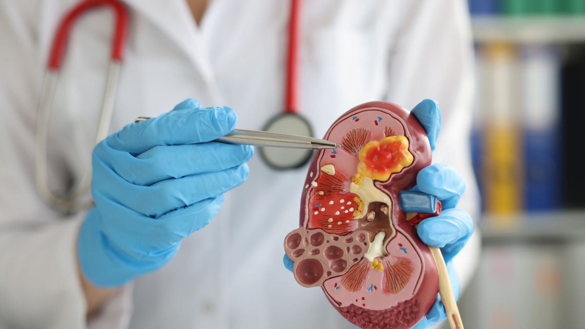 Il trapianto di microbiota potenzia l’immunoterapia nel tumore del rene avanzato