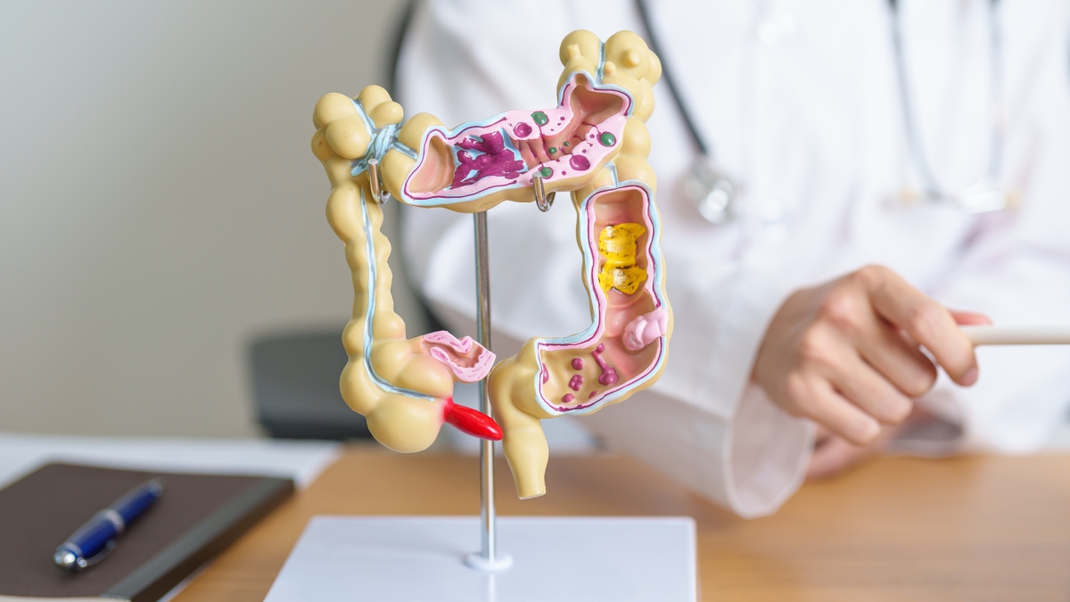 Tumore del colon-retto: negli Usa aumentano i decessi negli under 50. La situazione in Italia