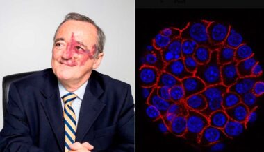 Tumore al pancreas, oncologo spagnolo trova la cura: combinazione di 3 farmaci. &laquo;Risultati mai osservati prima&raquo;