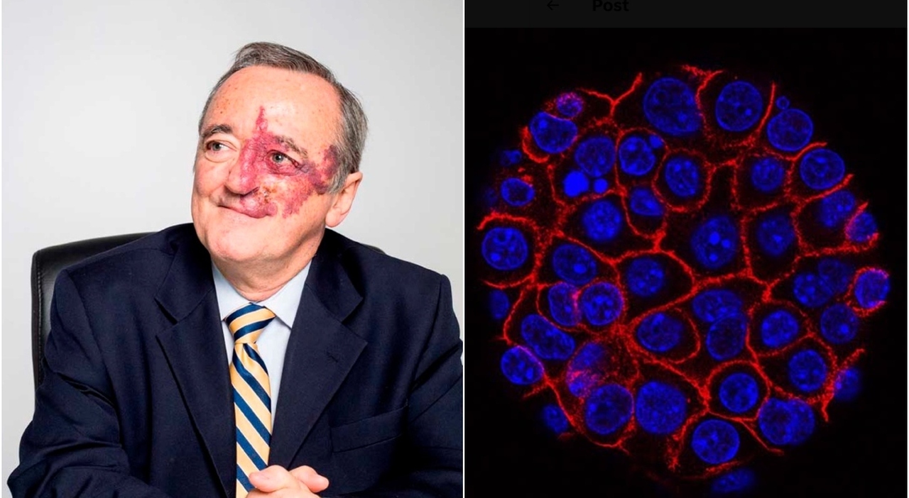 Tumore al pancreas, oncologo spagnolo trova la cura: combinazione di 3 farmaci. &laquo;Risultati mai osservati prima&raquo;