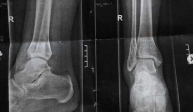 Corsa in ospedale, la regina di Canale 5 si è fratturata | L'incidente è stato molto violento