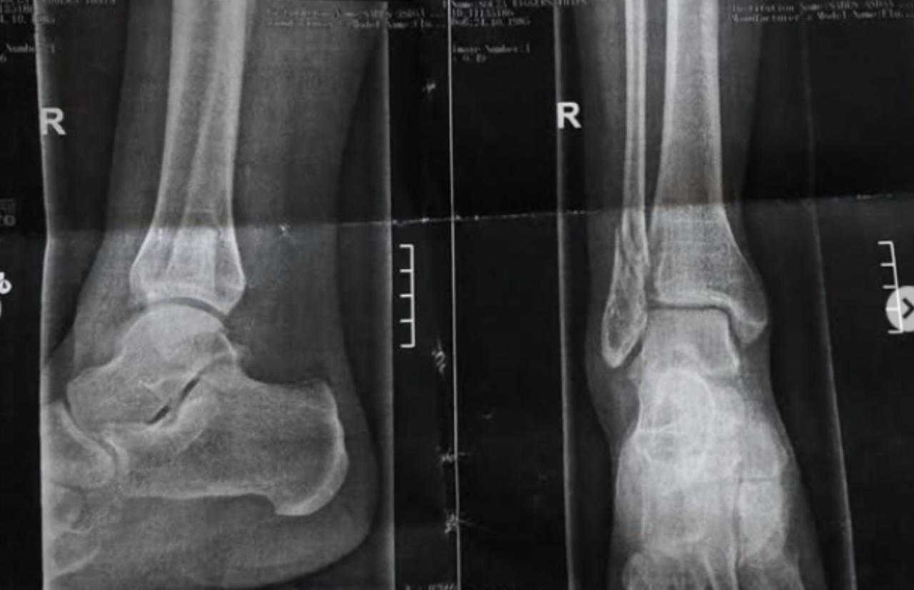 Corsa in ospedale, la regina di Canale 5 si è fratturata | L'incidente è stato molto violento