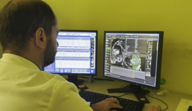 Mieloma multiplo, le cellule infiammatorie “predicono” sopravvivenza e recidive