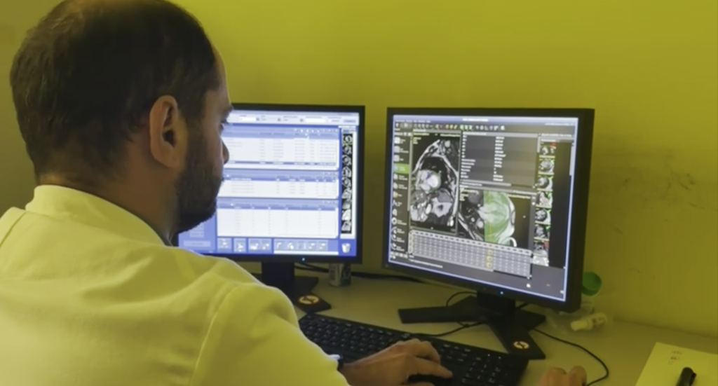 Mieloma multiplo, le cellule infiammatorie “predicono” sopravvivenza e recidive