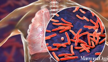 Studente positivo alla tubercolosi: non ci sono rischi rilevanti di contagio