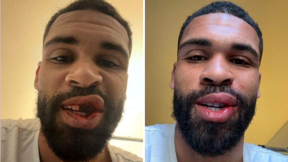 Milan, Loftus-Cheek operato ai denti: torna tra 2 mesi