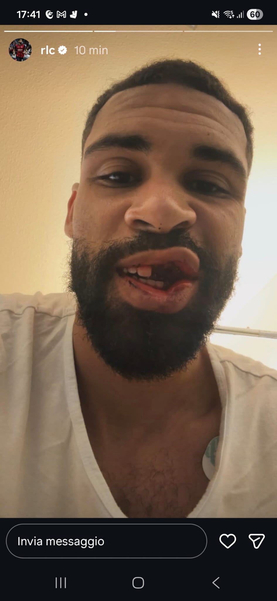 Ruben Loftus Cheek mascella frattura Milan-Parma Corvi