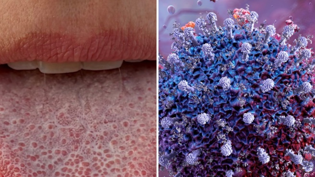 Covid, scoperta una causa della perdita di gusto prolungata dopo l'infezione