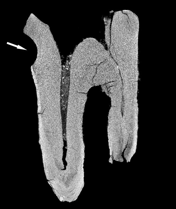 Il dentista di 59.000 anni fa: i Neanderthal trapanavano le carie con strumenti di pietra (e senza anestesia)