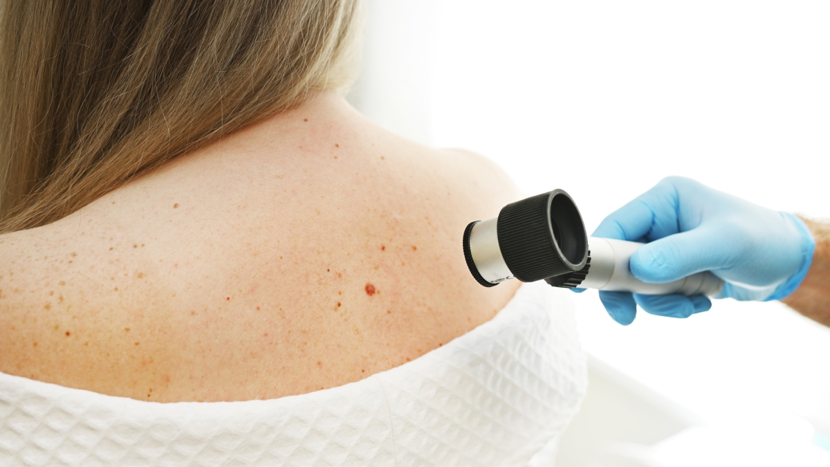 Melanoma, risultati positivi per il vaccino a mRna (la stessa tecnologia usata contro il Covid) personalizzato