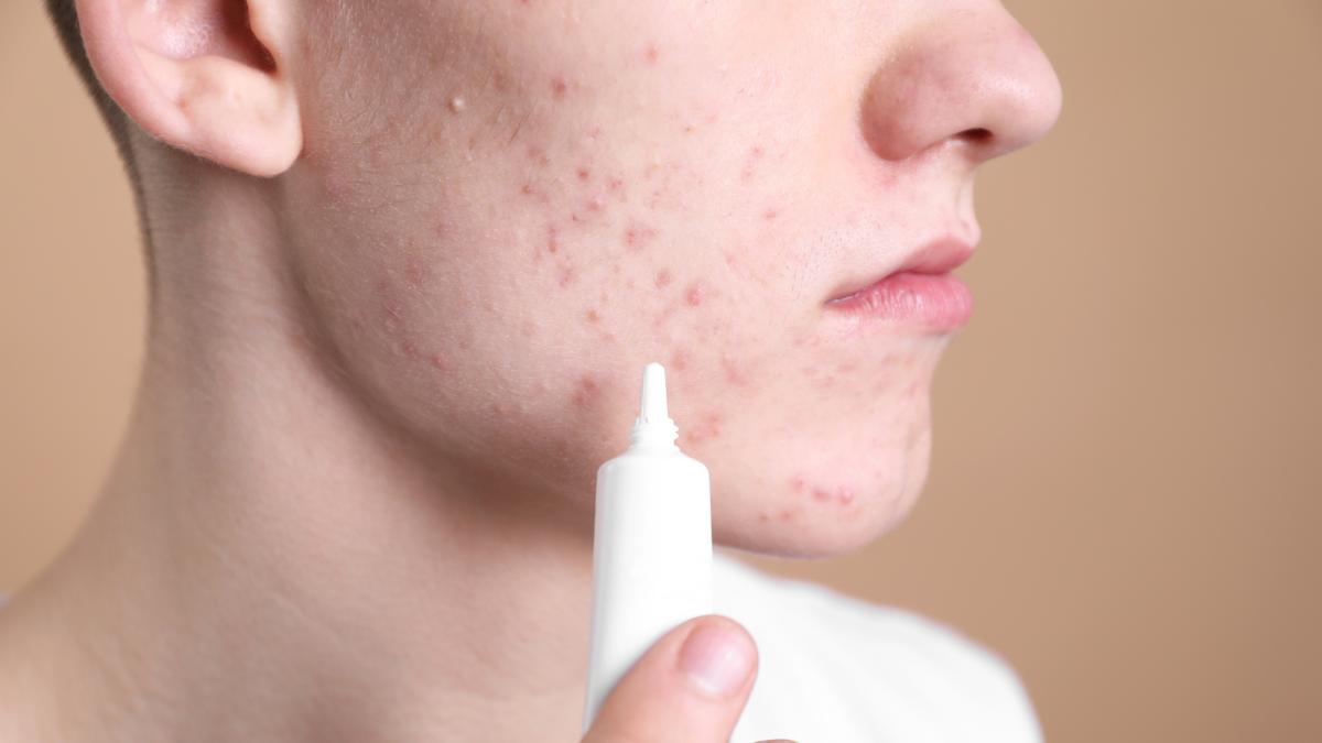 Acne: quanto incide l’alimentazione e quali cibi aiutano a ridurla