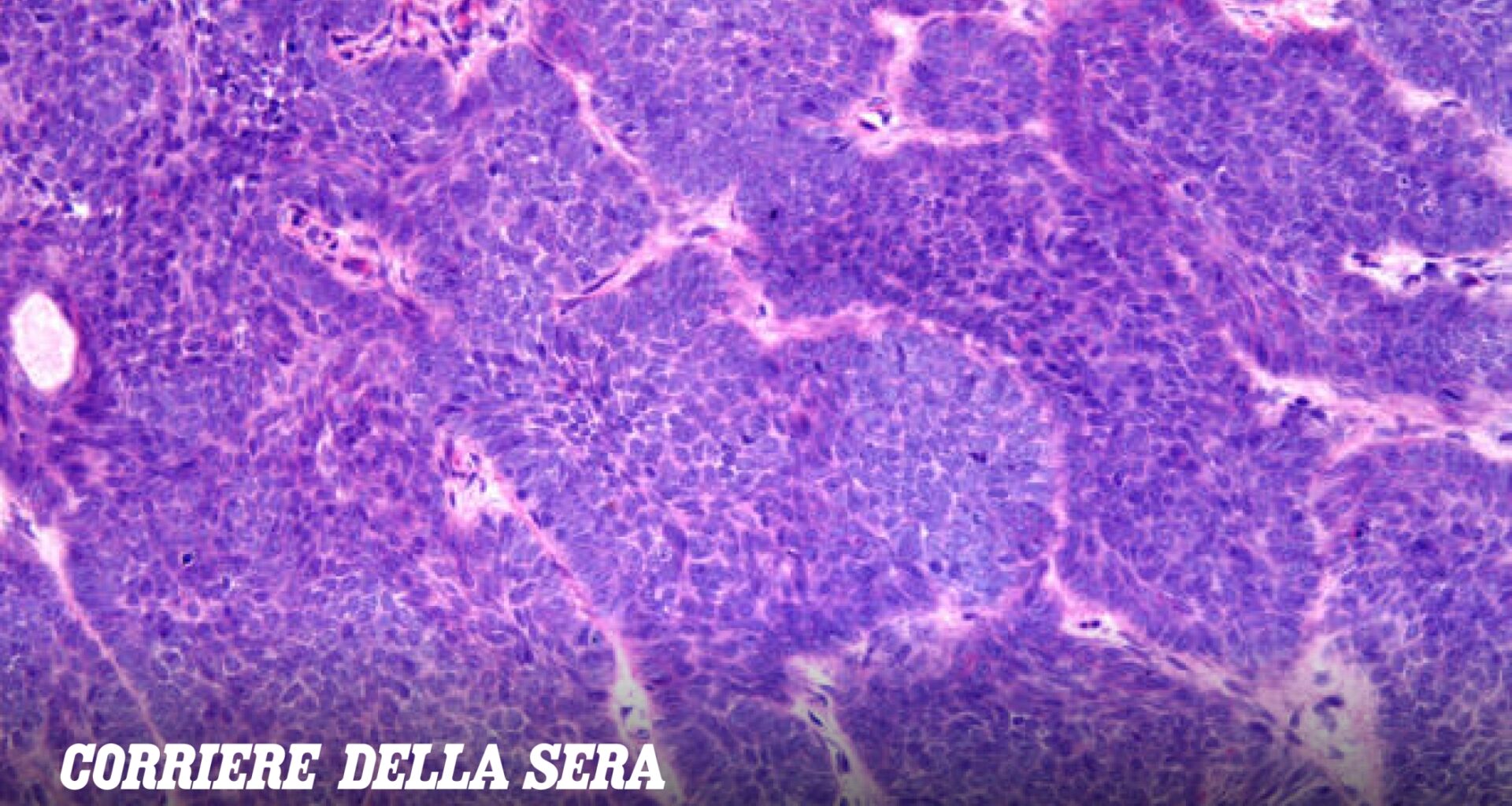 Che cos'è il carcinoma basocellulare o basalioma diagnosticato al rapper Salmo