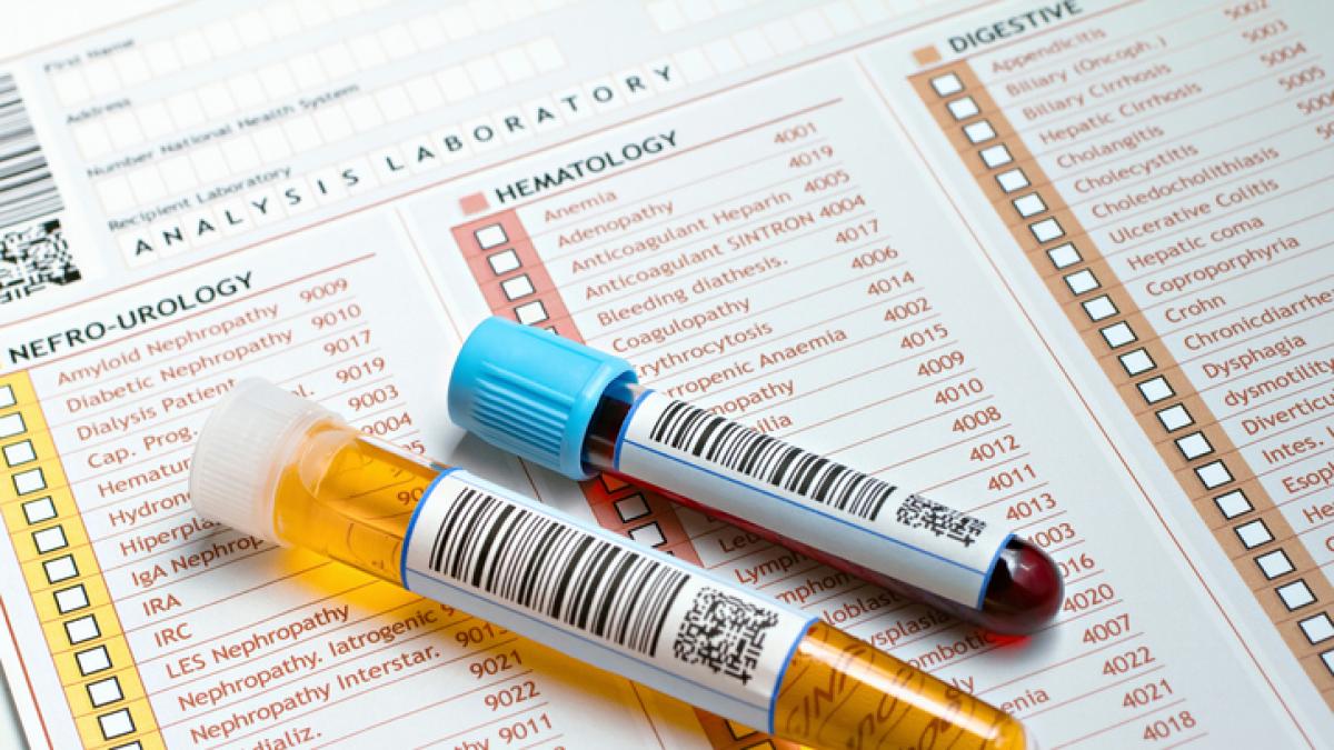 Tumore a vescica: addio cistoscopia? Test fai da te scova 9 casi su 10