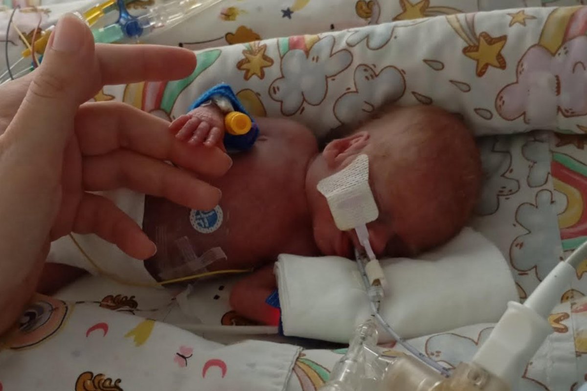 Pateikė daugiau detalių apie antrą pagal mažumą išgyvenusią naujagimę