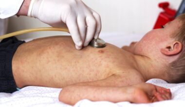 Į Kanadą sugrįžo tymai - Delfi sveikata