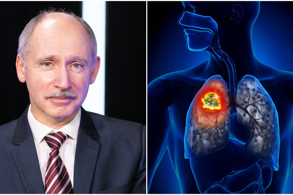 Kodėl plaučių vėžys nustatomas ir nerūkantiems?