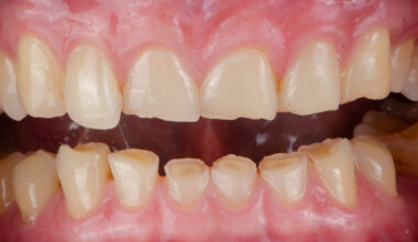 Išradimas sukėlė ažiotažą: mokslininkai sukūrė gelį, galintį pakeisti dantų gydymo ateitį