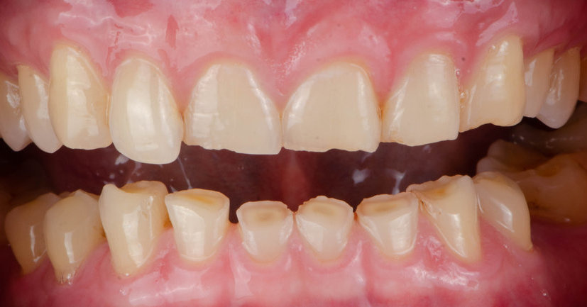 Išradimas sukėlė ažiotažą: mokslininkai sukūrė gelį, galintį pakeisti dantų gydymo ateitį