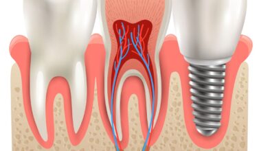 Ar dantų implantai – visam gyvenimui? Mitai ir realybė - Respublika.lt