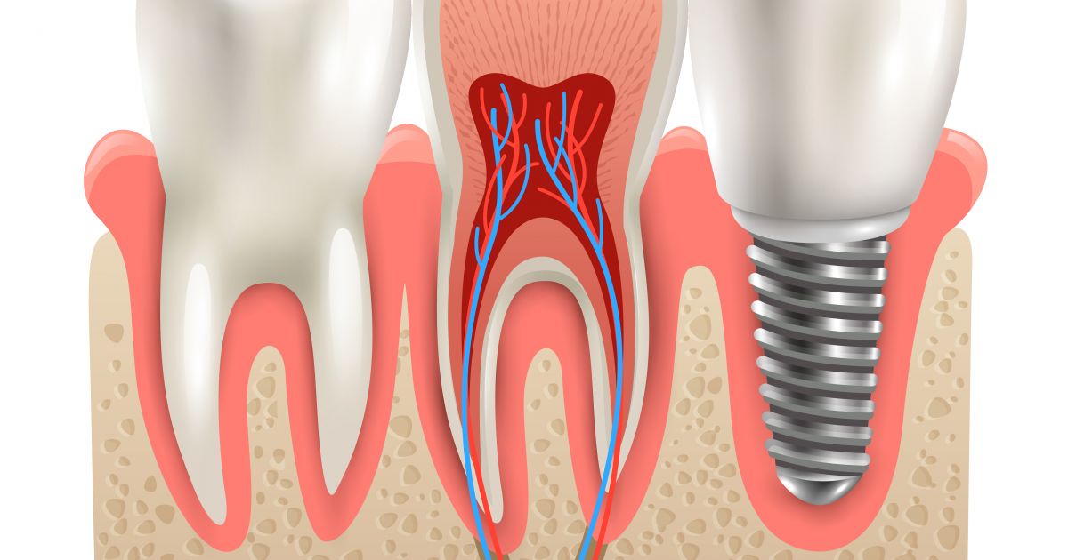Ar dantų implantai – visam gyvenimui? Mitai ir realybė - Respublika.lt