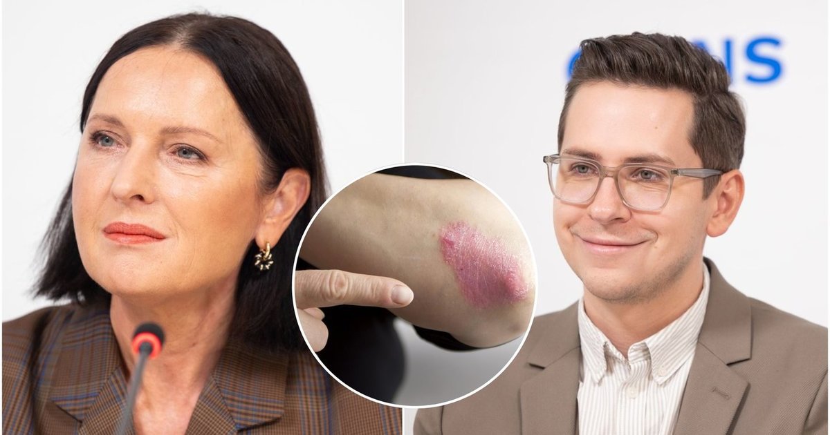 Už mažo bėrimo gali slypėti didelė bėda – padidina net infarkto, diabeto riziką