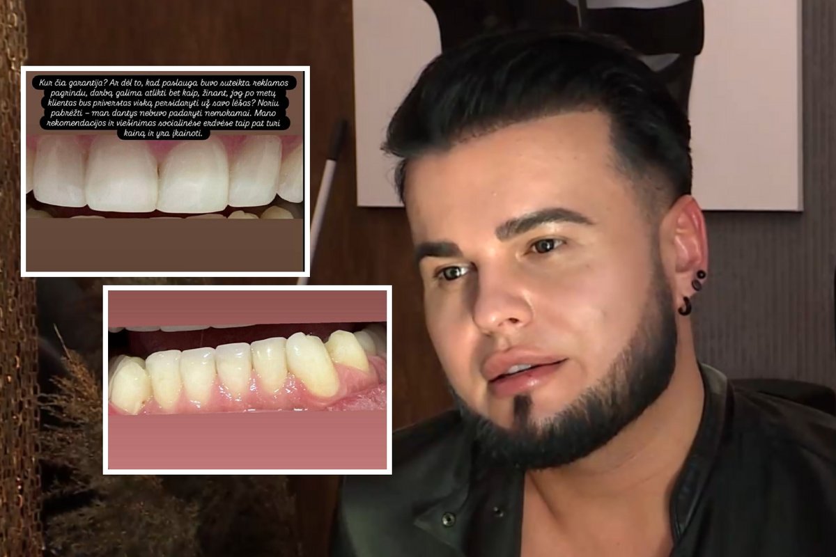 Vytenis Partikas pasipiktino odontologų darbu – parodė, kas po metų liko iš jo dantų