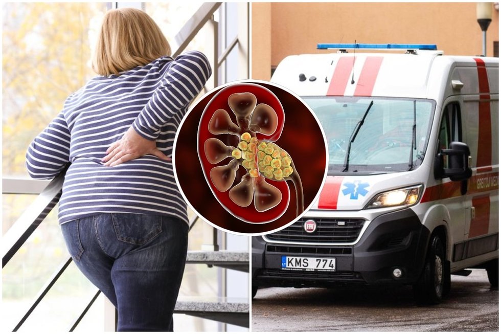 Gydytojas atskleidė, kokie požymiai išduoda inkstų akmenligę (tv3.lt fotomontažas)