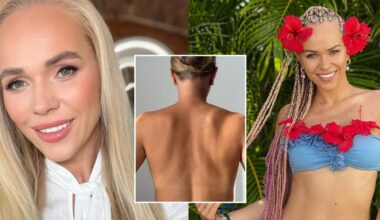 Odos nelygumus parodžiusi Ieva Voveris prasitarė – kovoja su infekcija