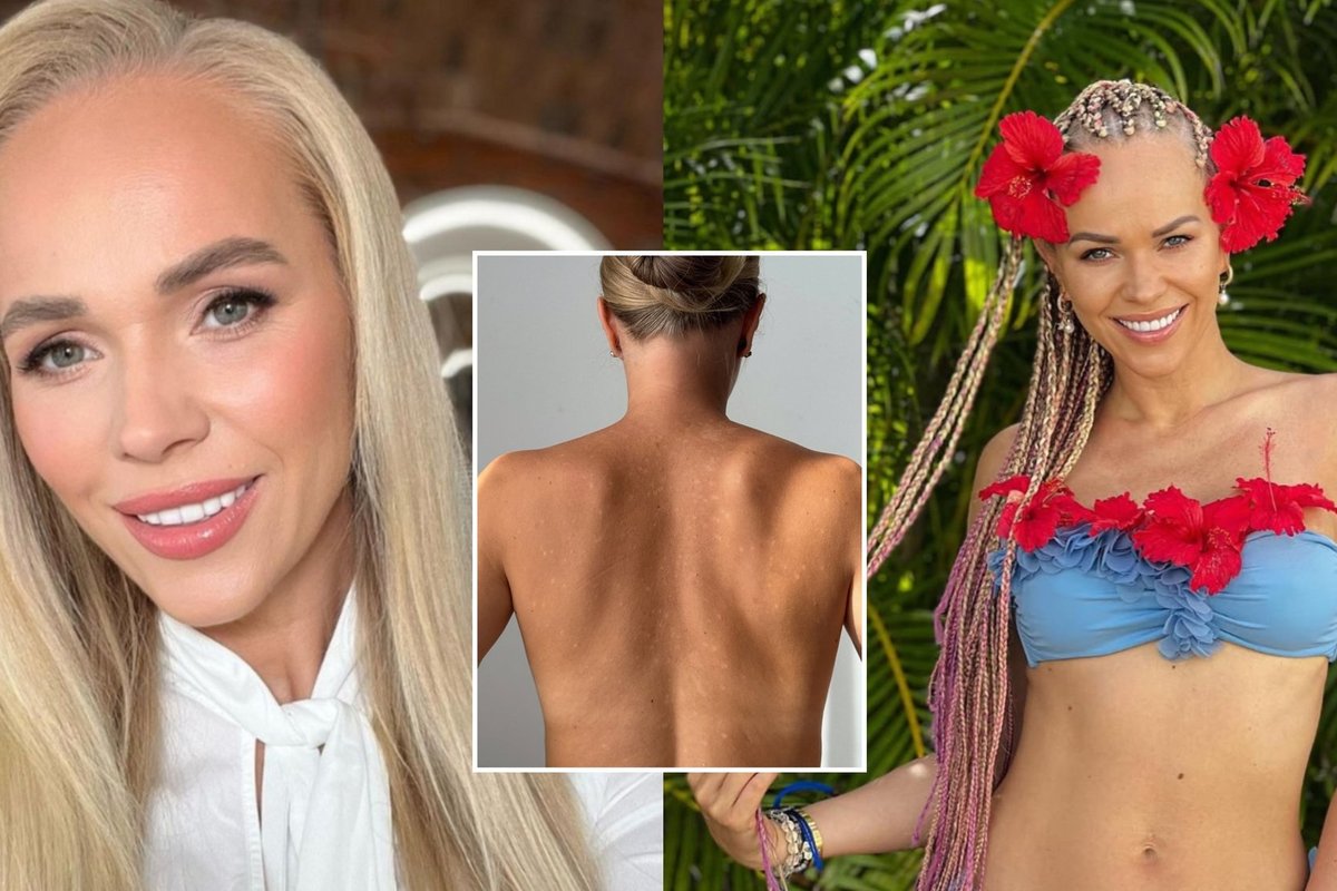 Odos nelygumus parodžiusi Ieva Voveris prasitarė – kovoja su infekcija