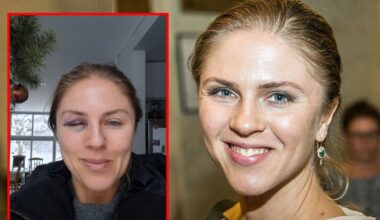 Editos Užaitės nuotrauka su „mėlyna“ akimi – suglumino: atskleidė, kas nutiko | Vardai